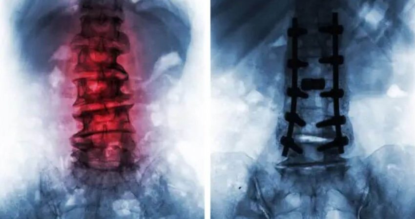 Radiofrecuencia para dolor de columna tras cirugía