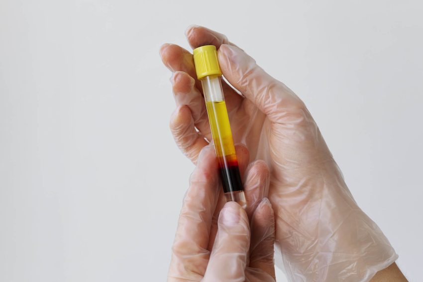 Plasma rico en plaquetas (PRP) | Dermoestética en Sevilla